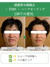 ブプラ 代々木上原店(BUPURA)/小顔×たるみ改善