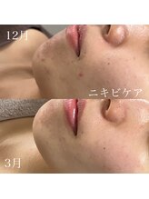 リュウ(le.lieu)/3ヶ月でニキビケア悩みから脱出