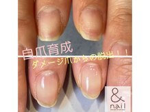 アンドネイル 海老名(&nail)/ダメージ爪からの変化