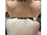 ミクロのHARIで背中ニキビケア　90分