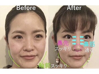 ラプリナーゼ 吉祥寺店(Raplit Nase)/隆鼻＋輪郭小顔矯正40分10回