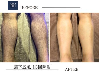 メンズメイド(Mens'Made)/before/after