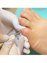 巻き爪補正店 鎌倉大船店/1.副爪の箇所を取り除く