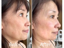 ドクターボディ 新宿店(Dr.Body)/【たるみ/立体小顔　50代】