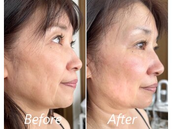 ドクターボディ 新宿店(Dr.Body)/【たるみ/立体小顔 50代】