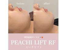 シャンス(Chance)の雰囲気(ピーチリフト 症例)