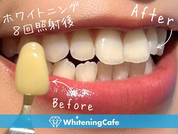 ホワイトニングカフェ 仙台店(WhiteningCafe)/☆歯のホワイトニング施術写真☆