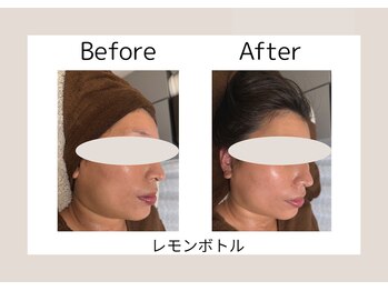 美成(vise)/ビフォーアフター