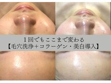 ラリマ グラマラス(Larima Glamorous)/くすみ・透明感UP（３回）