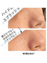 ライチャス(RAICHAS)/ハイドロフェイシャル