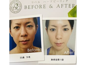 ラフィール/ハ-ブピ-リング:1回 &nbsp;美白 毛穴