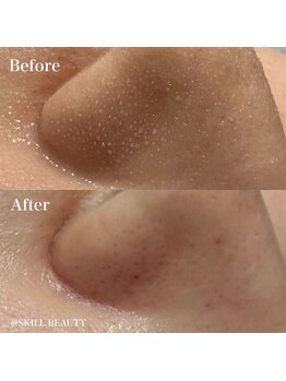 スキル アイラッシュ(SKILL eyelash)/毛穴洗浄☆ウォーターピーリング