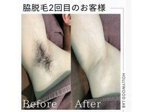 デェア コミータ/脇脱毛