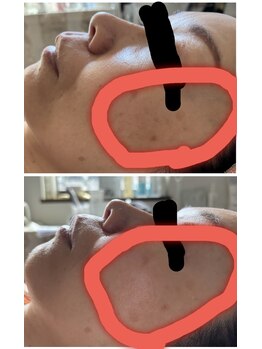 ピュア(Pure)/白玉ホワイトスノーピール