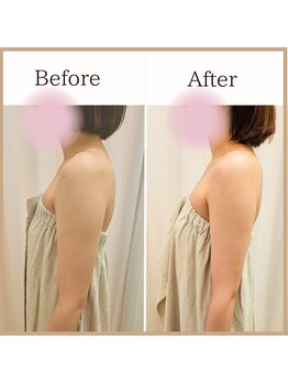 サロンルーチェ(Salon Luce)/ビフォーアフター/施術回数1回