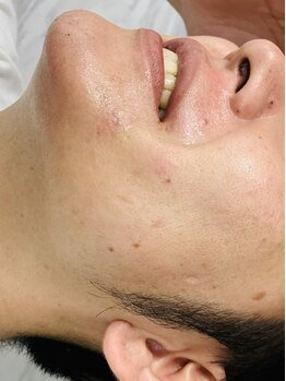 ハイドア(high door)の写真/《毎朝の髭剃りから卒業しませんか？》清潔感＆第一印象UPにはhigh doorオススメの【顔脱毛☆】