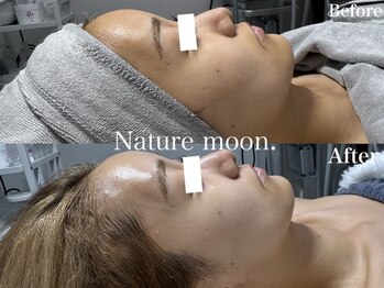 ナチュールムーン(Nature moon.)/ハーブピーリング
