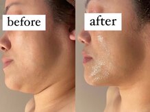 ウィズルーチェ 麻布十番店(with luce)/年齢によるフェスラインのたるみ