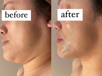 ウィズルーチェ 麻布十番店(with luce)/年齢によるフェスラインのたるみ