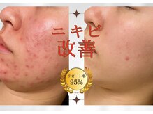 てて整骨院 針ヶ谷店の雰囲気（ハーブピーリングで大人ニキビでもここまで改善♪男性も可能◎）
