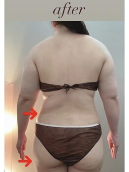 ブリス エナジーアンドサロン 福岡薬院店(bliss energy&salon)/エナジー(マシーン) after