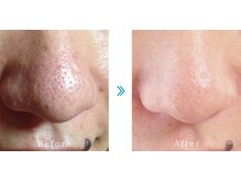 ラ リノ 星ヶ丘(La Lino)/毛穴スッキリ！