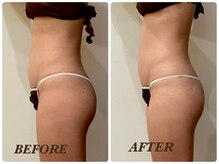 プリマ 栄店(Prima)/【2回施術】　BEFORE＆AFTER