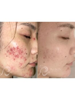 美白ケアをしたい