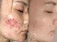ビースキン 藤沢店(BeSkin)の写真/【肌荒れ/シミ改善/ニキビケアの決定版】高濃度ビタミンCピーリングで肌質改善、くすみケア＆美白にも◎