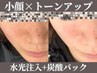 小顔×トーンアップ★針なし水光注入+カーボキシ炭酸パック¥17600→¥8800