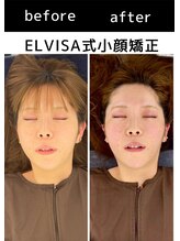 エレヴィザ トウキョウ 恵比寿院(ELVISA TOKYO)/ELVISA式小顔矯正　初回施術