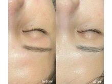 ダリアビューティー(Dahlia Beauty)/イラストリアスbefore after