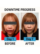 ミカド 銀座(mikado)/リフト後/輪郭術/インディバ