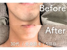 ユング 渋谷店(YUNG)/【ヒゲ脱毛】肌荒れ・赤み軽減◎
