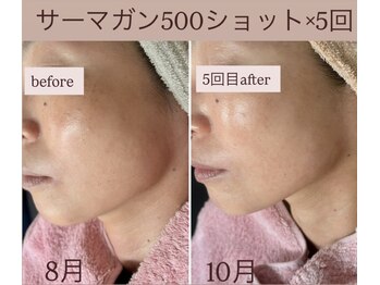 ピュルテ/サーマガン1回目→5回目効果!