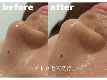 ホワイトラボ 堺東(White labo)/【10代女性 施術1回の効果】