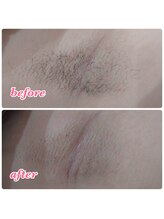 メローワックス 仙台東口店(MELLOW WAX)/ダブル脱毛【両脇】