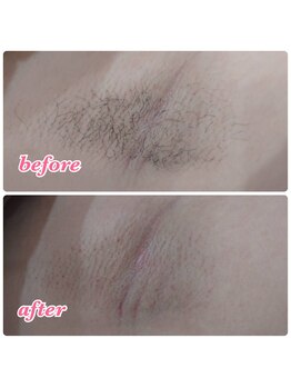 メローワックス 仙台東口店(MELLOW WAX)/ダブル脱毛【両脇】