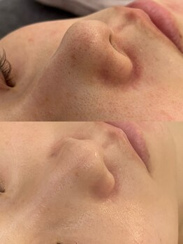 リリー(LILLY)の写真/剥離なしも選べる話題の“海洋源由来のハーブピーリング”☆施術翌日からメイク可能です!