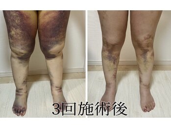術後インディバ専門サロン 新宿の写真/吸引・骨術後インディバ専門店！浮腫・こわばりをインディバ集中ケア！術後インディバで長く通える専門店