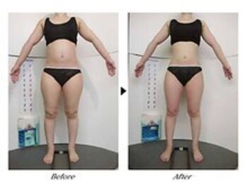 ビューティークリニックコダマ 日向店/【1か月コース】Y.H様(27歳)