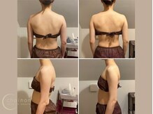 シェノン(chainon)/Before/After 【二の腕＆背中】