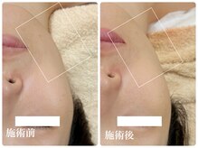 キーオブフェイス(Key of Face)/お悩み【顎下のたるみ脂肪】