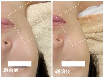 キーオブフェイス(Key of Face)/お悩み【顎下のたるみ脂肪】