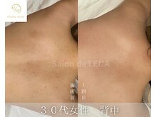 サロンドレナ 名駅店/ハーブピーリング サロンドレナ