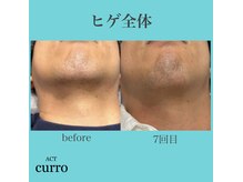 アクト クロ(ACT curro)/【ヒゲ全体】脱毛施術例