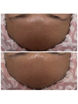 シュガー(Sugar...iyr)/光フェイシャル