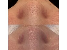 ナチュリー(Naturry)/毛穴トラブルには毛穴肌管理を。