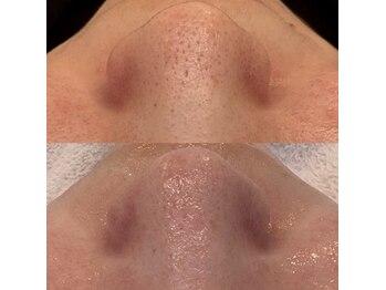 ナチュリー(Naturry)/毛穴トラブルには毛穴肌管理を。