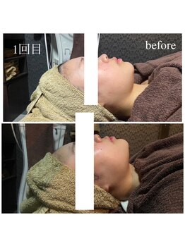 ラクラク(rakuraku)/リフトアップフェイシャル【女】